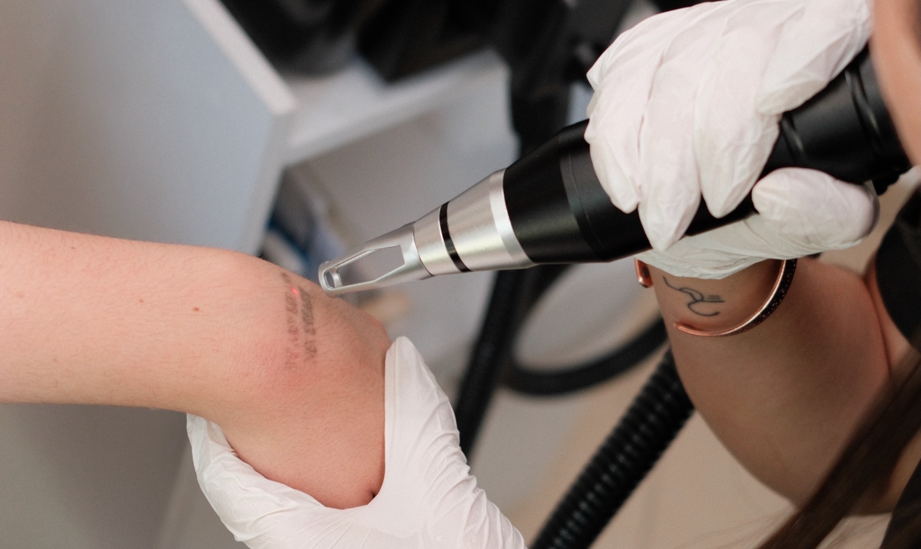 Eliminación de tatuajes con láser en NUA Glow Spa, León Guanajuato