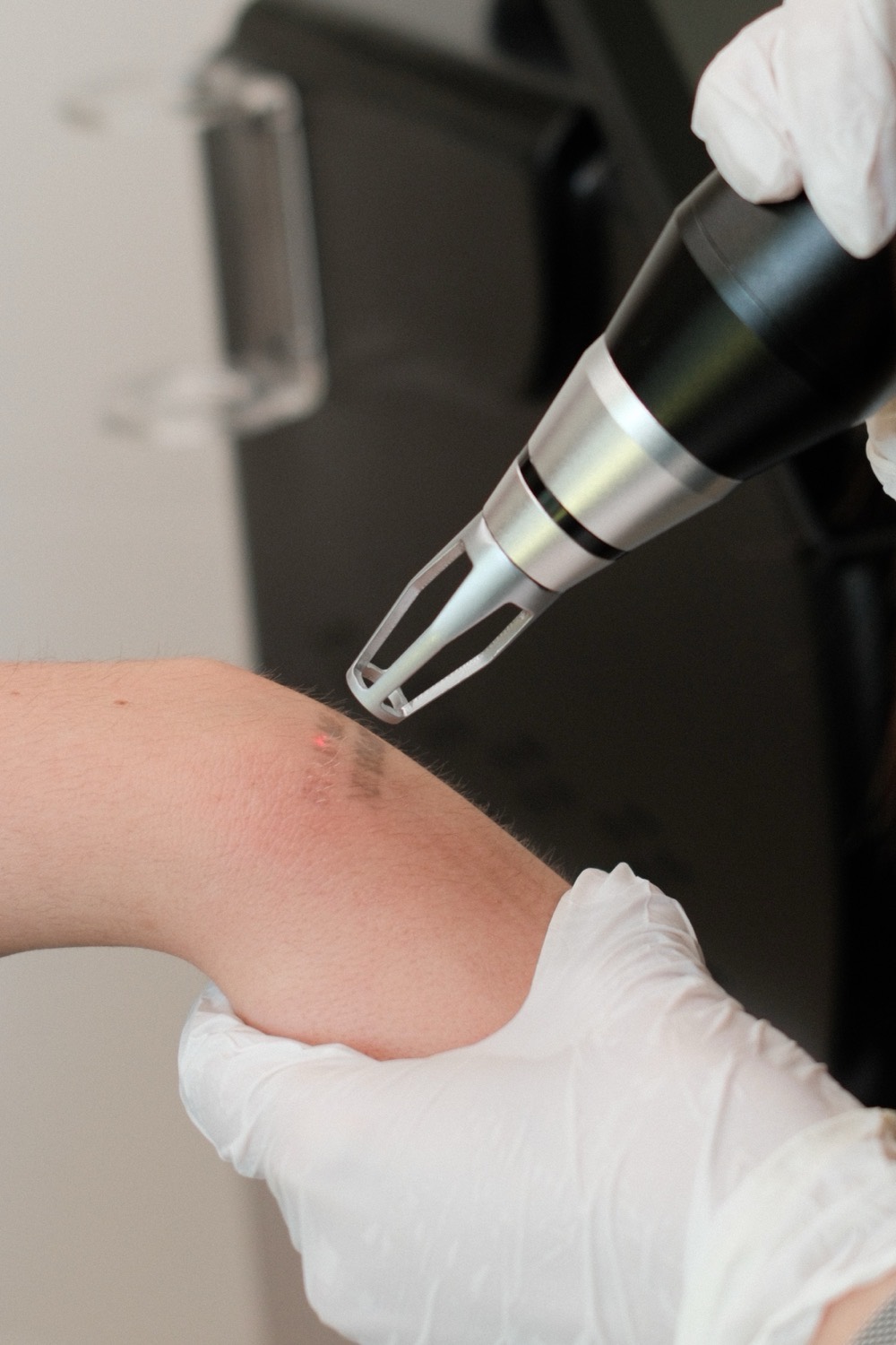 Sesión de eliminación de tatuaje con láser en el antebrazo · NUA Glow Spa, León
